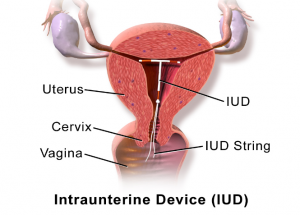 IUD Denton 